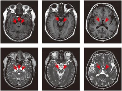 Case report: Episodic psychosis caused by a novel SCP2 splicing mutation